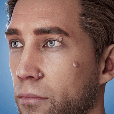 TopSpire® 2-in-1 Microneedle & Hydrocolloid Patch | Targeted Solution for Raised Moles, Acne, Flat Warts & Skin Tags | Helps Improve the Appearance of Fine Lines, Scars & Skin Imperfections | Invisible Star Pimple Patches for Face & Body