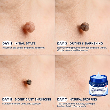 🇺🇸 Natravor® 7-𝐃𝐚𝐲 𝐒𝐤𝐢𝐧 𝐓𝐚𝐠 & 𝐒𝐩𝐨𝐭 𝐄𝐫𝐚𝐬𝐞𝐫 𝐂𝐫𝐞𝐚𝐦 (Zero Pain, Zero 𝐒𝐜𝐚𝐫𝐬 Formula) 💎