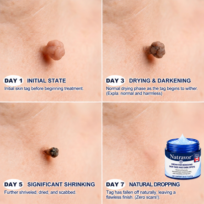 Natravor® 7-𝐃𝐚𝐲 𝐒𝐤𝐢𝐧 𝐓𝐚𝐠 & 𝐒𝐩𝐨𝐭 𝐄𝐫𝐚𝐬𝐞𝐫 𝐂𝐫𝐞𝐚𝐦 (Zero Pain, Zero 𝐒𝐜𝐚𝐫𝐬 Formula) 💎
