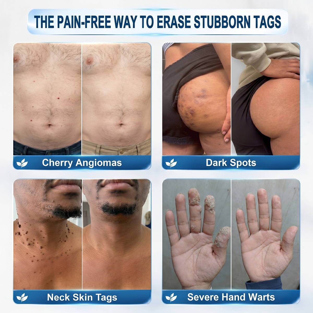 🇺🇸 Natravor® 7-𝐃𝐚𝐲 𝐒𝐤𝐢𝐧 𝐓𝐚𝐠 & 𝐒𝐩𝐨𝐭 𝐄𝐫𝐚𝐬𝐞𝐫 𝐂𝐫𝐞𝐚𝐦 (Zero Pain, Zero 𝐒𝐜𝐚𝐫𝐬 Formula) 💎