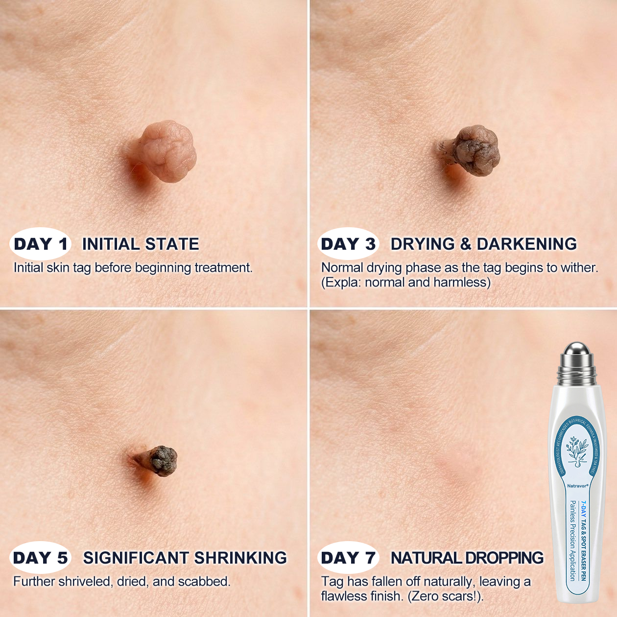 🇨🇦 Official Canada Store | Natravor® 7-Day Skin Tag & Blemish Roll-On – Painless & Scar-Free
