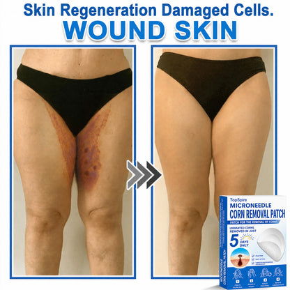 TopSpire® 2-in-1 Microneedle & Hydrocolloid Patch | Targeted Solution for Raised Moles, Acne, Flat Warts & Skin Tags | Helps Improve the Appearance of Fine Lines, Scars & Skin Imperfections | Invisible Star Pimple Patches for Face & Body