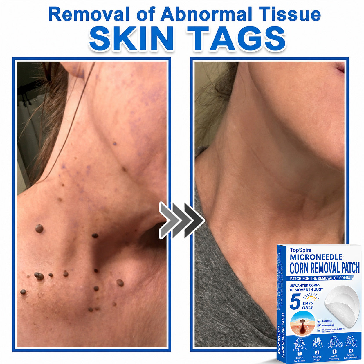 TopSpire® 2-in-1 Microneedle & Hydrocolloid Patch | Targeted Solution for Raised Moles, Acne, Flat Warts & Skin Tags | Helps Improve the Appearance of Fine Lines, Scars & Skin Imperfections | Invisible Star Pimple Patches for Face & Body
