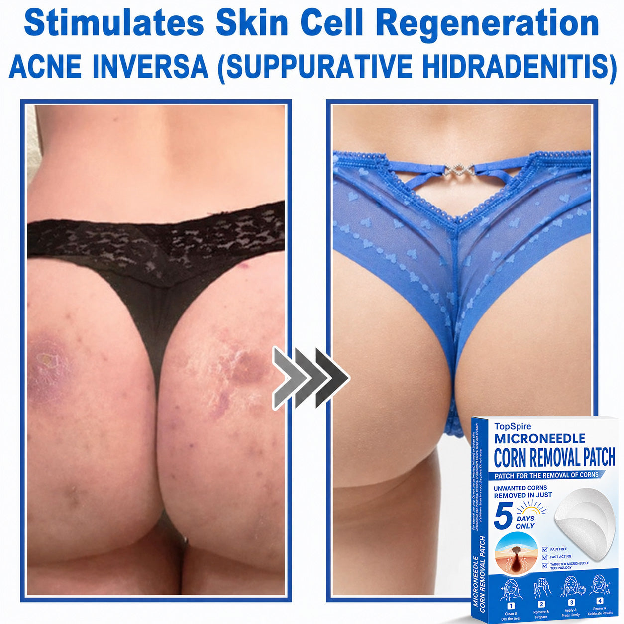 TopSpire® 2-in-1 Microneedle & Hydrocolloid Patch | Targeted Solution for Raised Moles, Acne, Flat Warts & Skin Tags | Helps Improve the Appearance of Fine Lines, Scars & Skin Imperfections | Invisible Star Pimple Patches for Face & Body