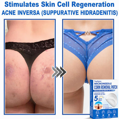 TopSpire® 2-in-1 Microneedle & Hydrocolloid Patch | Targeted Solution for Raised Moles, Acne, Flat Warts & Skin Tags | Helps Improve the Appearance of Fine Lines, Scars & Skin Imperfections | Invisible Star Pimple Patches for Face & Body