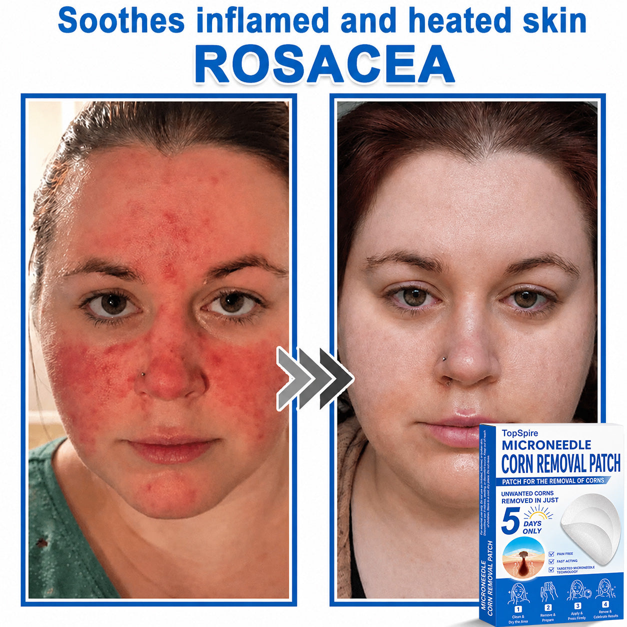 TopSpire® 2-in-1 Microneedle & Hydrocolloid Patch | Targeted Solution for Raised Moles, Acne, Flat Warts & Skin Tags | Helps Improve the Appearance of Fine Lines, Scars & Skin Imperfections | Invisible Star Pimple Patches for Face & Body