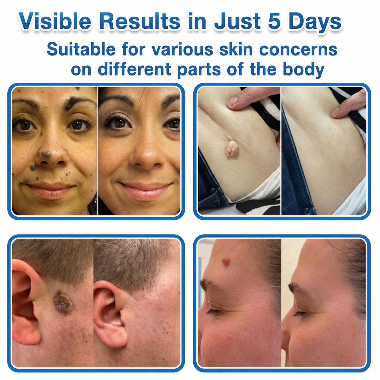 TopSpire® 2-in-1 Microneedle & Hydrocolloid Patch | Targeted Solution for Raised Moles, Acne, Flat Warts & Skin Tags | Helps Improve the Appearance of Fine Lines, Scars & Skin Imperfections | Invisible Star Pimple Patches for Face & Body
