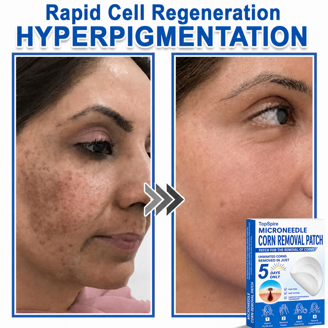 TopSpire® 2-in-1 Microneedle & Hydrocolloid Patch | Targeted Solution for Raised Moles, Acne, Flat Warts & Skin Tags | Helps Improve the Appearance of Fine Lines, Scars & Skin Imperfections | Invisible Star Pimple Patches for Face & Body