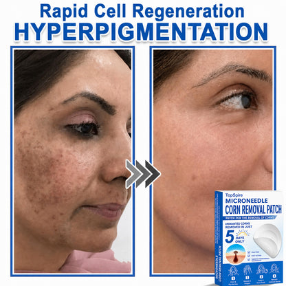 TopSpire® 2-in-1 Microneedle & Hydrocolloid Patch | Targeted Solution for Raised Moles, Acne, Flat Warts & Skin Tags | Helps Improve the Appearance of Fine Lines, Scars & Skin Imperfections | Invisible Star Pimple Patches for Face & Body