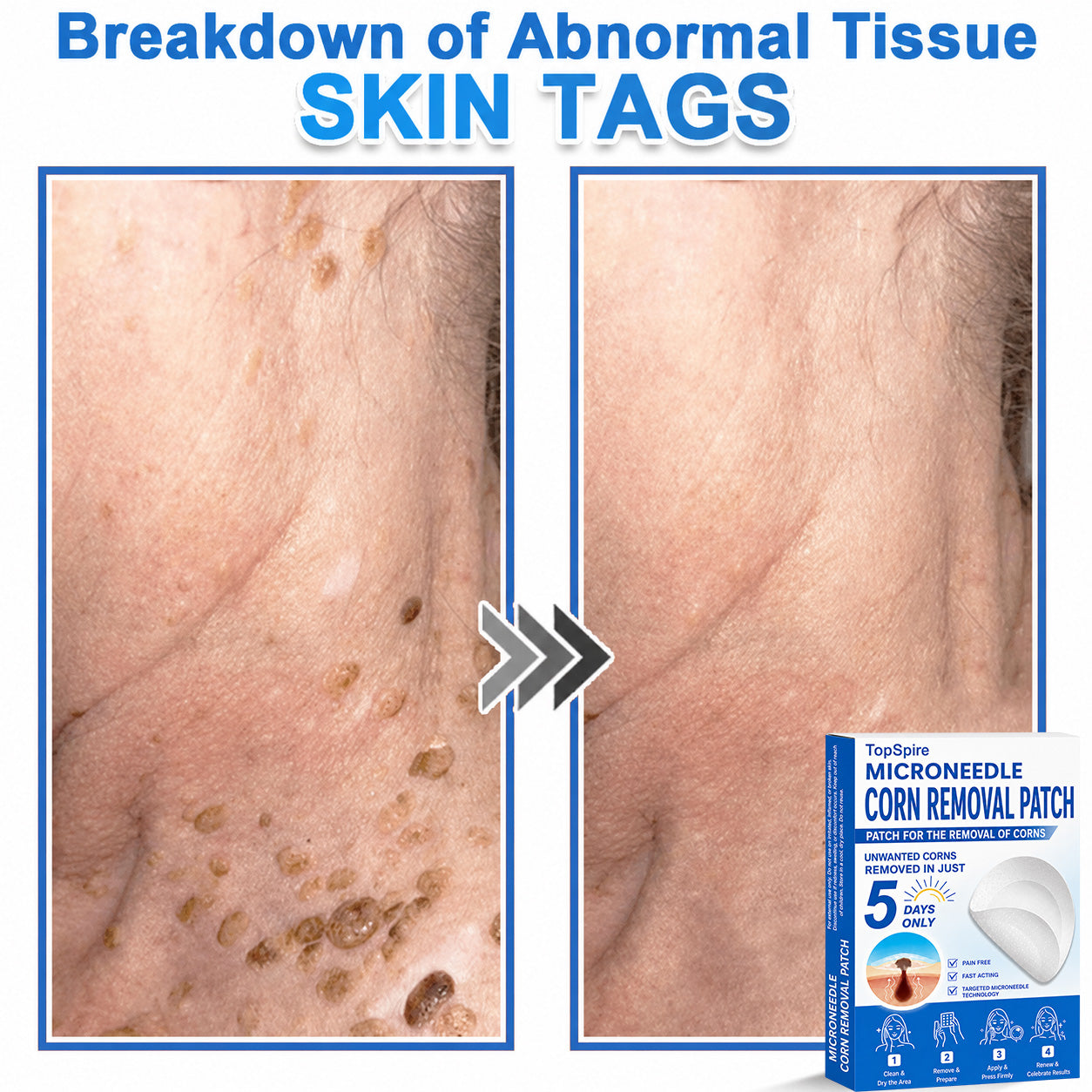 TopSpire® 2-in-1 Microneedle & Hydrocolloid Patch | Targeted Solution for Raised Moles, Acne, Flat Warts & Skin Tags | Helps Improve the Appearance of Fine Lines, Scars & Skin Imperfections | Invisible Star Pimple Patches for Face & Body