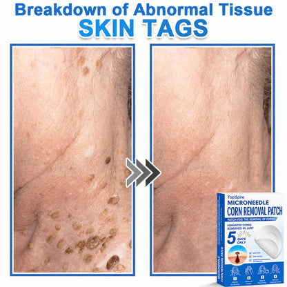 TopSpire® 2-in-1 Microneedle & Hydrocolloid Patch | Targeted Solution for Raised Moles, Acne, Flat Warts & Skin Tags | Helps Improve the Appearance of Fine Lines, Scars & Skin Imperfections | Invisible Star Pimple Patches for Face & Body