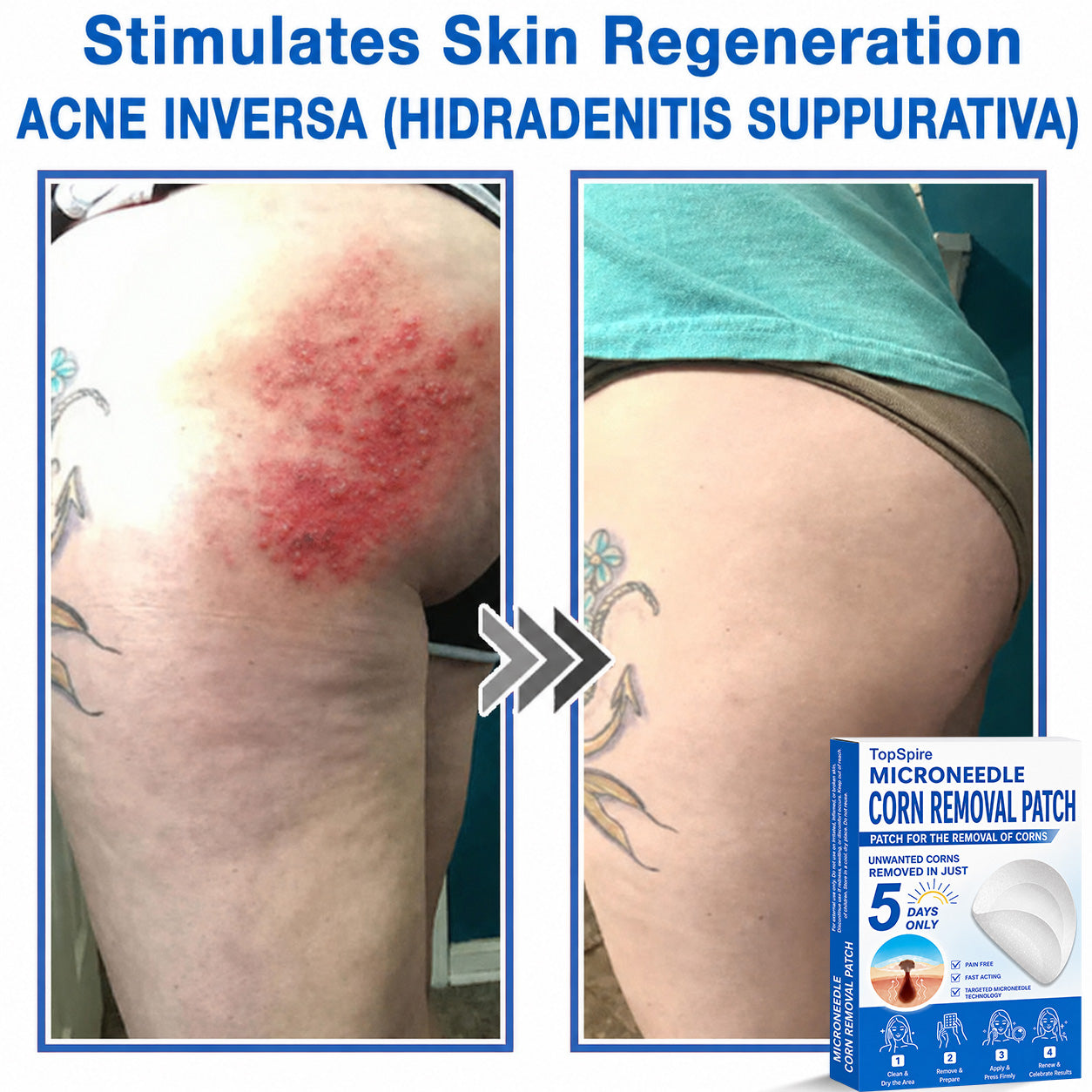 TopSpire® 2-in-1 Microneedle & Hydrocolloid Patch | Targeted Solution for Raised Moles, Acne, Flat Warts & Skin Tags | Helps Improve the Appearance of Fine Lines, Scars & Skin Imperfections | Invisible Star Pimple Patches for Face & Body